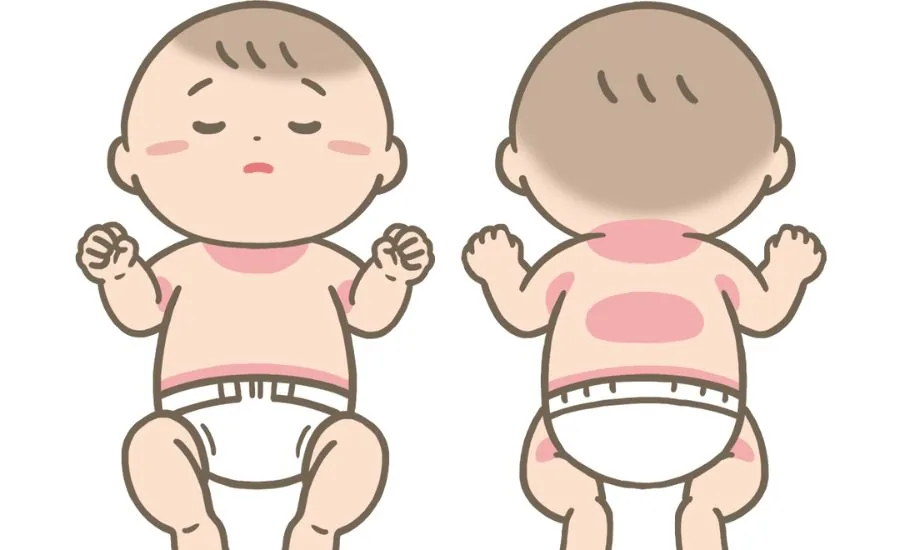 乳児湿疹ができやすい部位や状態の図解