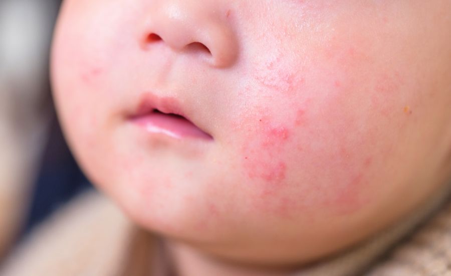 赤ちゃんの顔にできたブツブツや乳児湿疹の様子